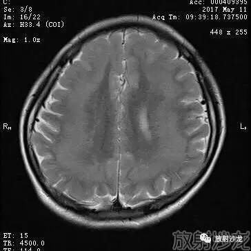 【病例】弥漫性带状灰质异位症1例MR