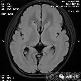 【病例】弥漫性带状灰质异位症1例MR