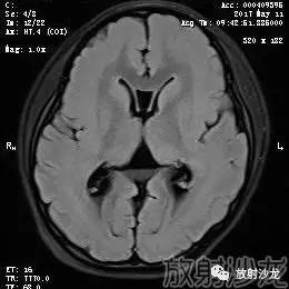 【病例】弥漫性带状灰质异位症1例MR