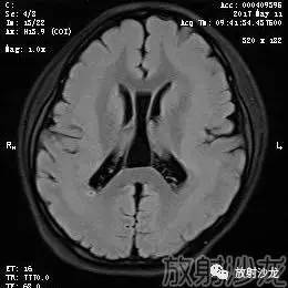 【病例】弥漫性带状灰质异位症1例MR