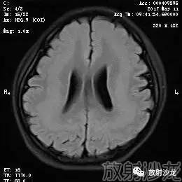 【病例】弥漫性带状灰质异位症1例MR