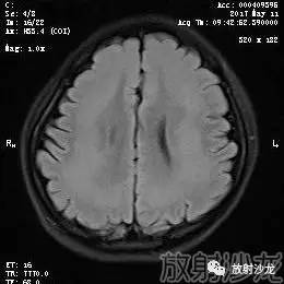 【病例】弥漫性带状灰质异位症1例MR