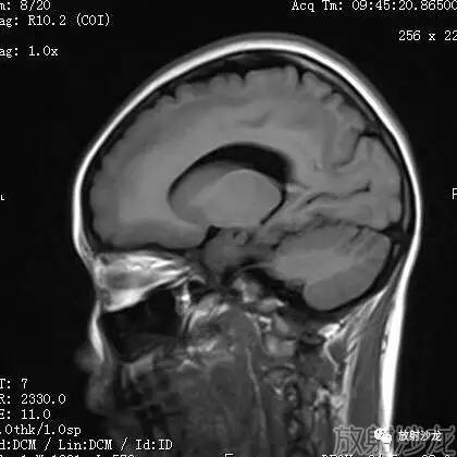 【病例】弥漫性带状灰质异位症1例MR