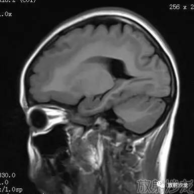 【病例】弥漫性带状灰质异位症1例MR