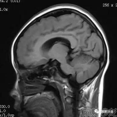 【病例】弥漫性带状灰质异位症1例MR