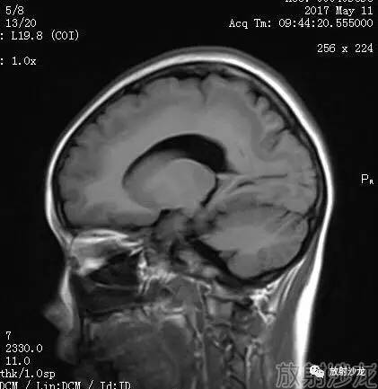 【病例】弥漫性带状灰质异位症1例MR