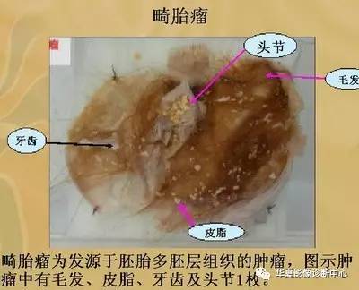 错构瘤与畸胎瘤