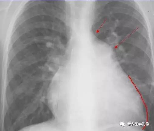 引起肺血增多的8种先天性心脏病