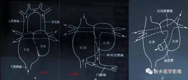 引起肺血增多的8种先天性心脏病 引起肺血增多的8种先天性心脏病