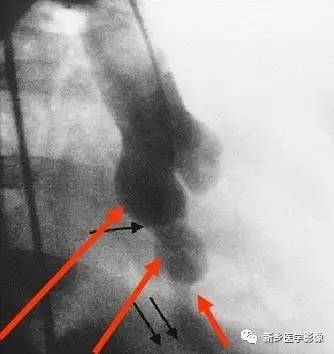 引起肺血增多的8种先天性心脏病 引起肺血增多的8种先天性心脏病