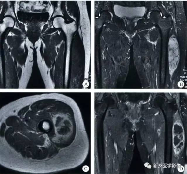 【病例】左大腿滑膜肉瘤1例MR影像表现