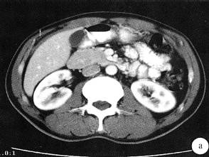 【病例】环状胰腺1例CT影像表现 【病例】环状胰腺1例CT影像表现