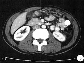 【病例】环状胰腺1例CT影像表现 【病例】环状胰腺1例CT影像表现