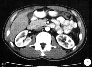 【病例】环状胰腺1例CT影像表现 【病例】环状胰腺1例CT影像表现
