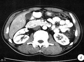 【病例】环状胰腺1例CT影像表现