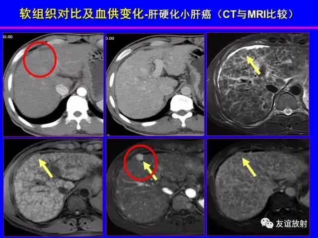 【PPT】肝胆胰脾常规MRI检查