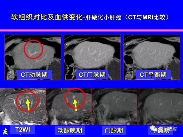 【PPT】肝胆胰脾常规MRI检查