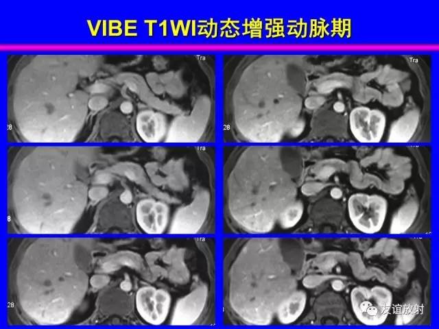 【PPT】肝胆胰脾常规MRI检查
