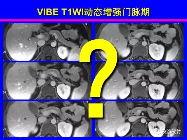 【PPT】肝胆胰脾常规MRI检查