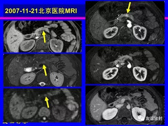 【PPT】肝胆胰脾常规MRI检查