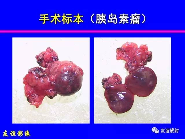 【PPT】肝胆胰脾常规MRI检查