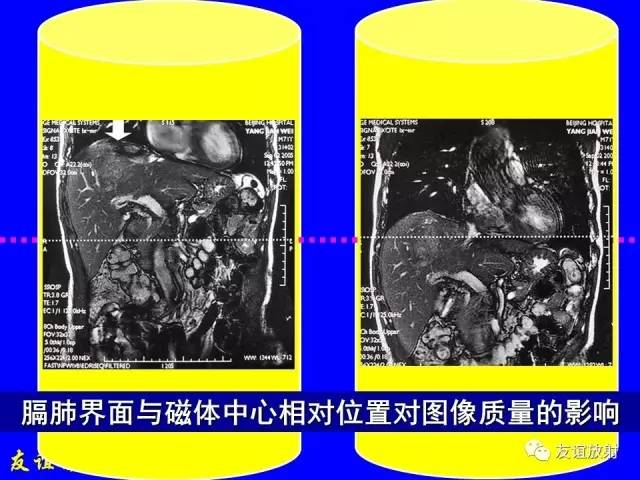 【PPT】肝胆胰脾常规MRI检查