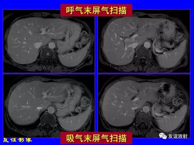 【PPT】肝胆胰脾常规MRI检查