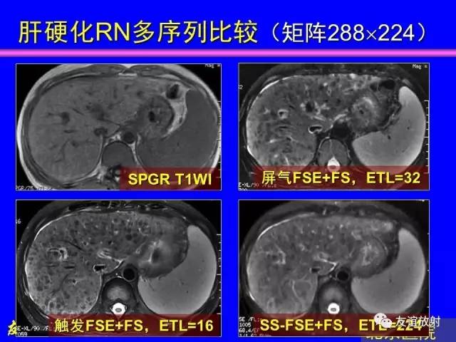 【PPT】肝胆胰脾常规MRI检查