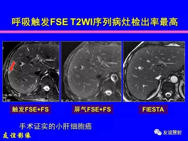 【PPT】肝胆胰脾常规MRI检查