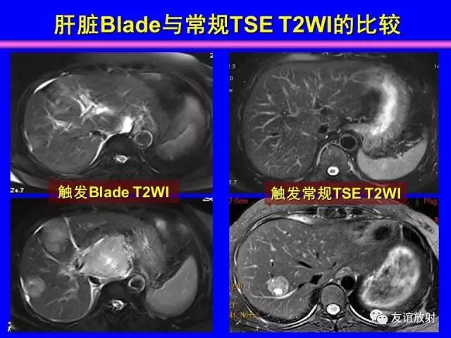 【PPT】肝胆胰脾常规MRI检查