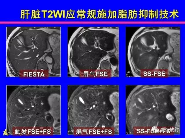 【PPT】肝胆胰脾常规MRI检查