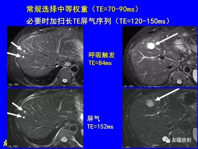 【PPT】肝胆胰脾常规MRI检查
