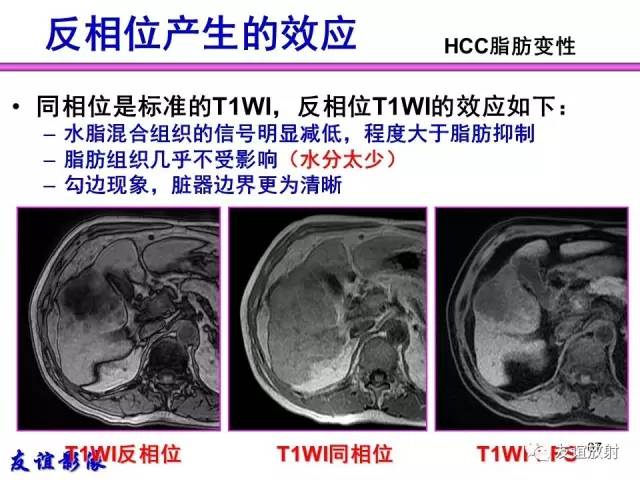 【PPT】肝胆胰脾常规MRI检查