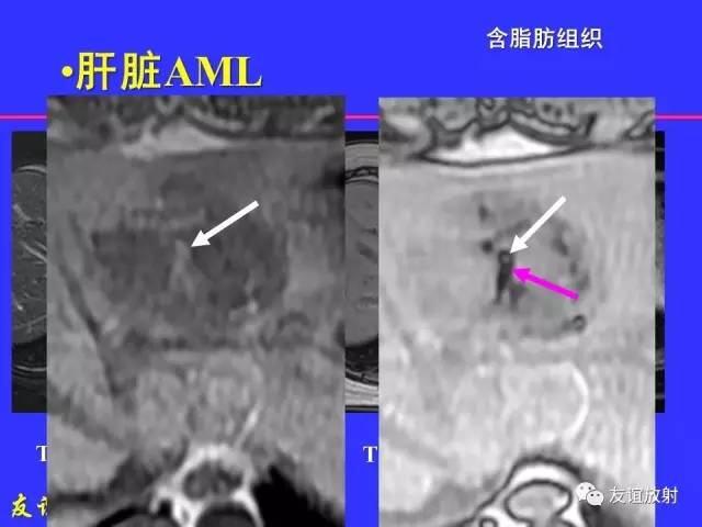 【PPT】肝胆胰脾常规MRI检查
