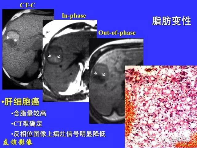 【PPT】肝胆胰脾常规MRI检查