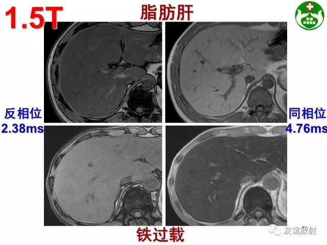 【PPT】肝胆胰脾常规MRI检查