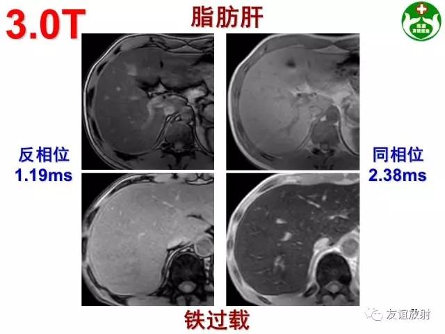 【PPT】肝胆胰脾常规MRI检查