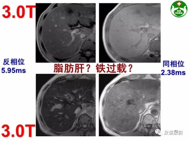 【PPT】肝胆胰脾常规MRI检查
