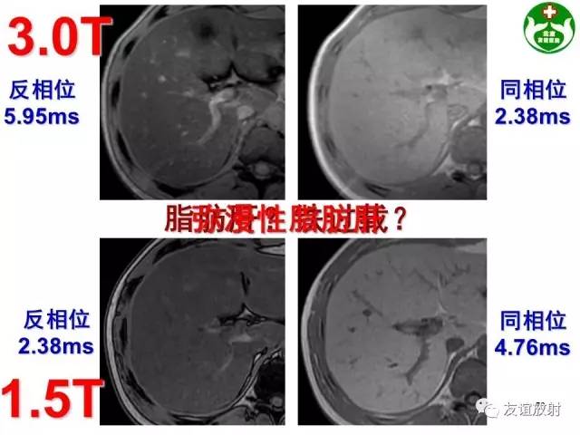 【PPT】肝胆胰脾常规MRI检查
