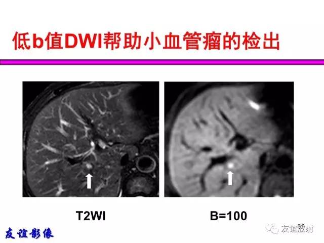 【PPT】肝胆胰脾常规MRI检查