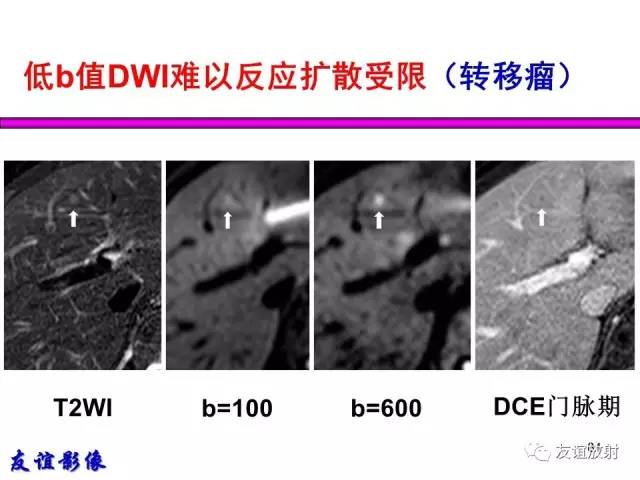 【PPT】肝胆胰脾常规MRI检查