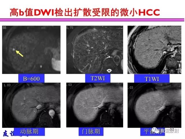 【PPT】肝胆胰脾常规MRI检查