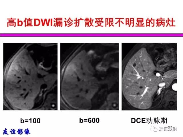 【PPT】肝胆胰脾常规MRI检查