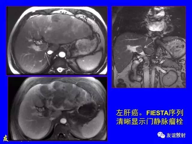 【PPT】肝胆胰脾常规MRI检查