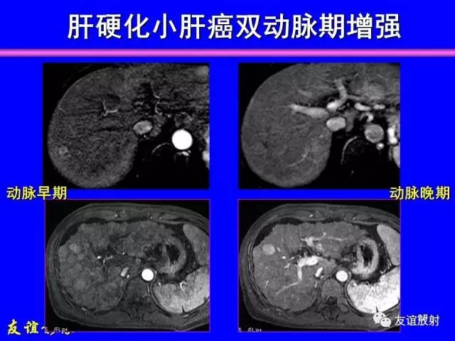 【PPT】肝胆胰脾常规MRI检查
