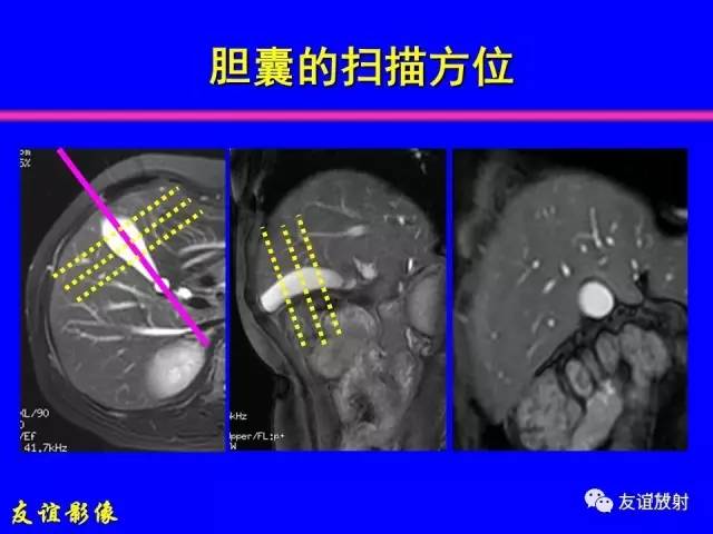 【PPT】肝胆胰脾常规MRI检查