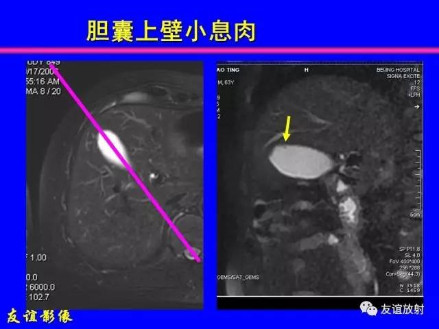 【PPT】肝胆胰脾常规MRI检查