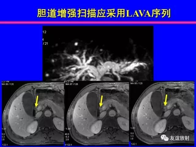 【PPT】肝胆胰脾常规MRI检查