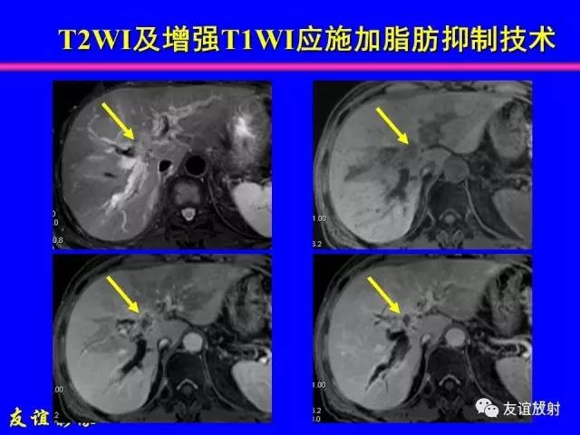 【PPT】肝胆胰脾常规MRI检查