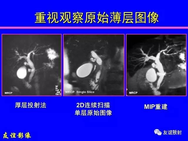 【PPT】肝胆胰脾常规MRI检查